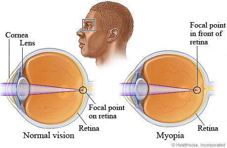 Nearsightedness (Myopia)